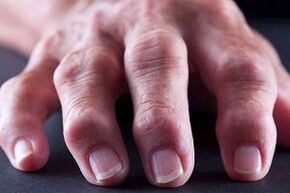 D'Haapt Differenzen vun Arthritis an Arthrosis