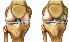 Diffinctive Zeeche vu gemeinsame Arthrosis