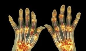 Wat ass den Ënnerscheed tëscht Arthritis aus Arthrosis vun de Gelenker
