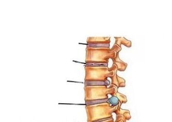 Véier Etappe vun der Entwécklung vun der Osteochondrosis